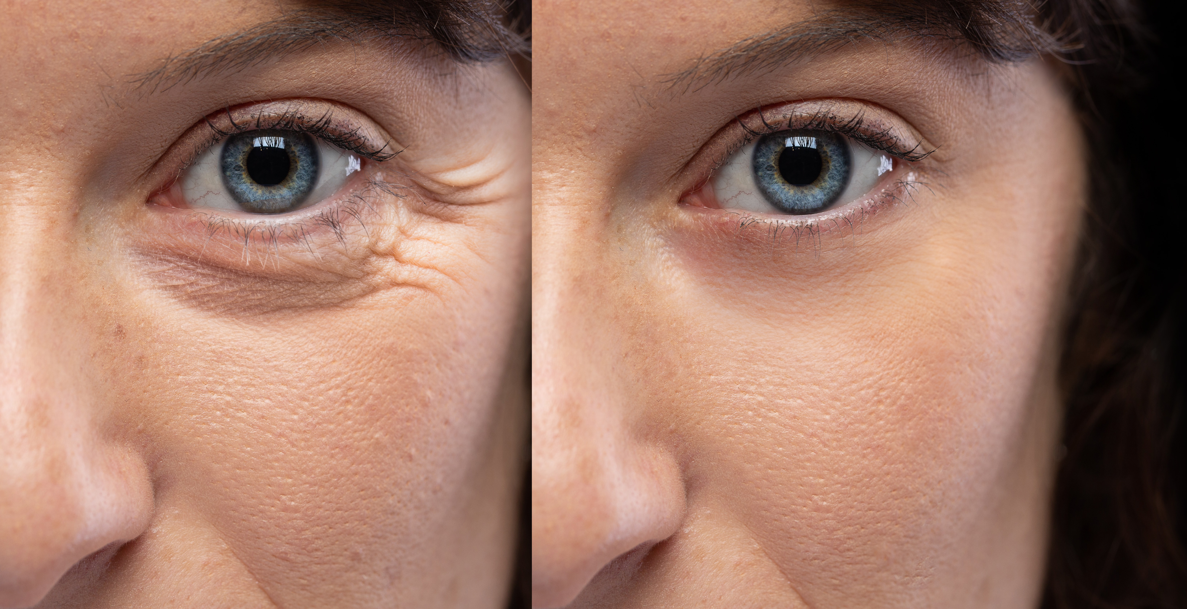 Before and After of changes of under eye hollows, crows feet 